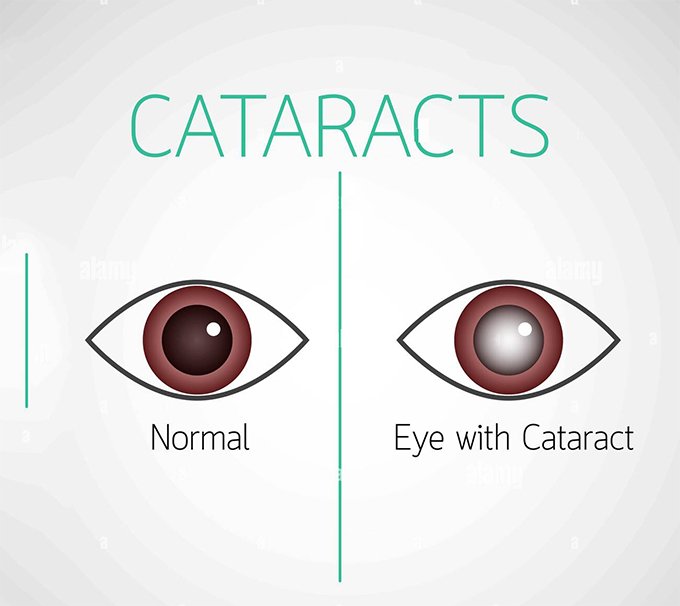 cataract