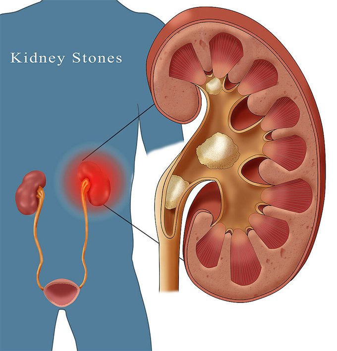 kidney stones